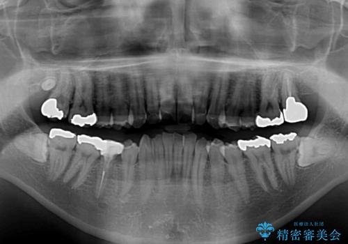 【モニター】飛び出した上の前歯 非抜歯矯正で整った口元にの治療前