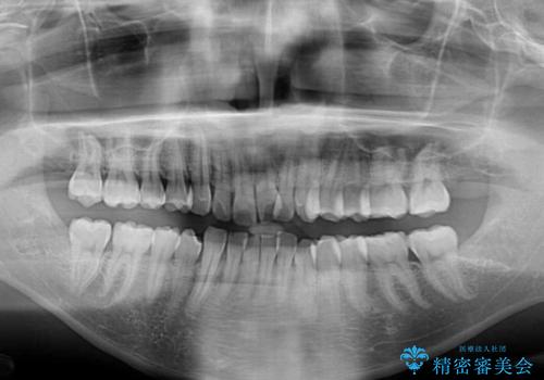 前方に捻れた前歯を治したい インビザライン矯正治療の治療前