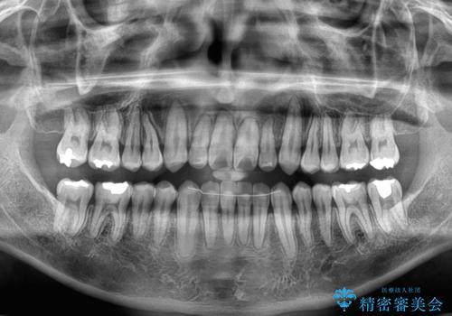 内側に引っ込んだ歯を治したい インビザラインの矯正治療の治療後