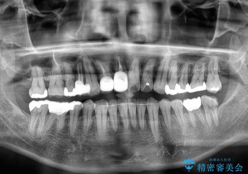 隠れている前歯 インビザライン矯正治療と前歯のセラミック治療の治療後