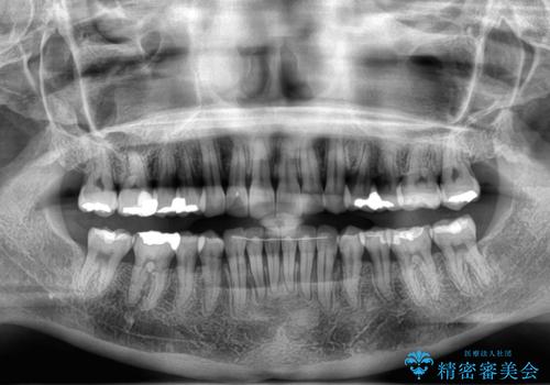 ディープバイトと前歯のデコボコ インビザラインによる矯正治療の治療後