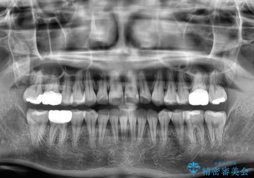 上下前歯のデコボコ ワイヤー装置で楽ちん矯正治療の治療後