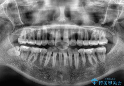 上下非接触の前歯 口元の突出感を改善する抜歯矯正の治療後