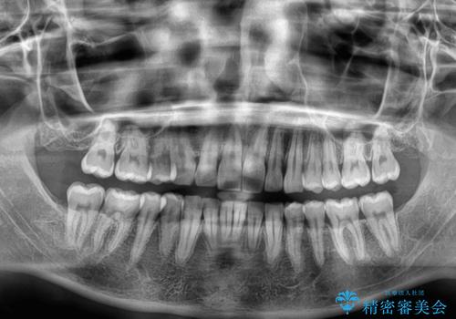 深い咬み合わせと前歯のデコボコ ワイヤー装置での抜歯矯正の治療後