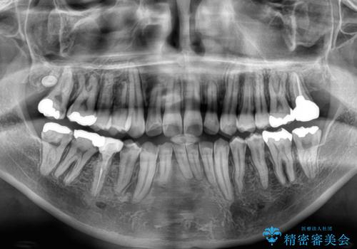 【モニター】飛び出した上の前歯 非抜歯矯正で整った口元にの治療後