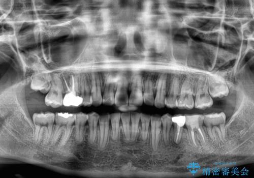 【モニター】デコボコ前歯を治したい ワイヤー装置での抜歯矯正治療の治療後