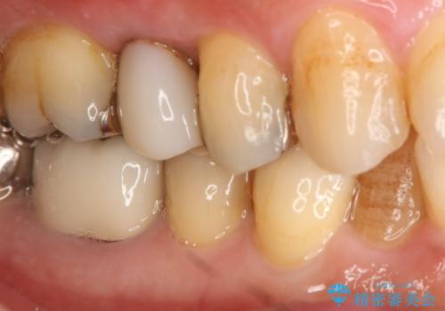 保険材料をセラミックにやり変えたい セラミックインレーの治療前