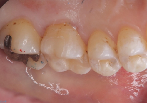 【セラミックインレー】銀の詰め物が外れてしまったの治療後