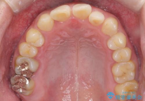 前歯のすき間 歯のがたつきの治療前