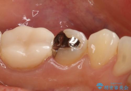 銀歯を白くしたい セラミックインレーの治療前
