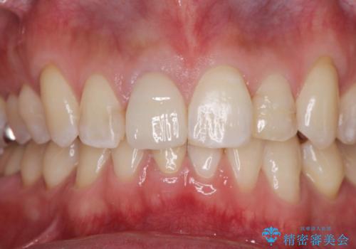 奥に引っ込んでいる前歯を並べたい 矯正治療とセラミック治療の治療後