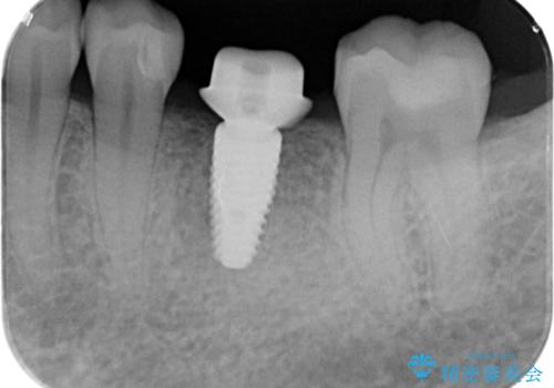 欠損部のインプラント補綴の治療中