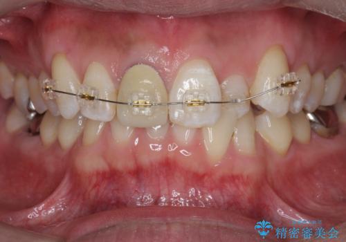 奥に引っ込んでいる前歯を並べたい 矯正治療とセラミック治療の治療中