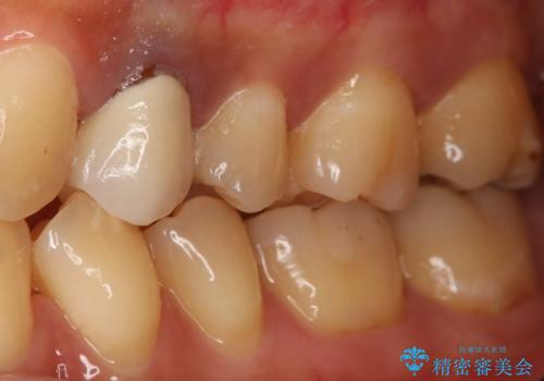 う蝕除去中に露髄 フルジルコニアクラウンの治療前