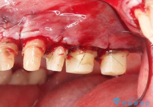 虫歯だらけの歯を治療したいの治療前