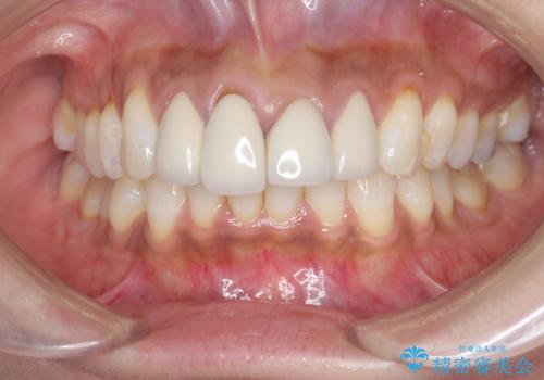 金属色の見える前歯 オールセラミックで審美治療の治療前