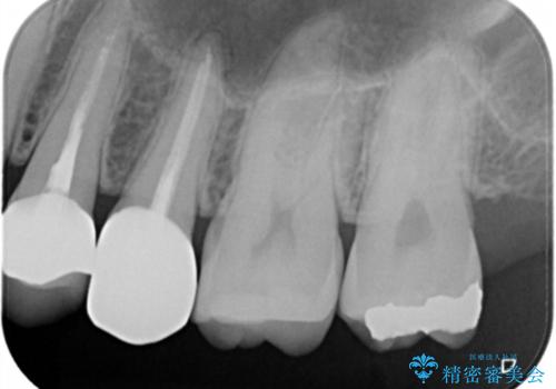 う蝕除去中に露髄 フルジルコニアクラウンの治療後
