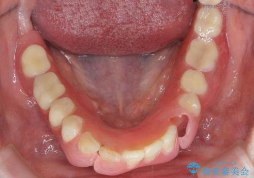 入れ歯が揺れて食事しにくい(インプラント支台義歯)の治療)の症例 治療前