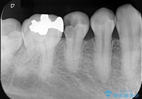 虫歯治療|歯を長持ちさせるための治療|セラミッククラウン|審美回復|精密根管治療の治療前