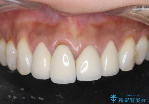 金属色の見える前歯 オールセラミックで審美治療の症例 治療前