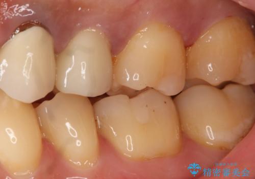 銀歯のやり変え希望 セラミックインレーの治療後
