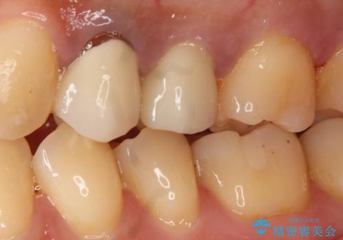 う蝕除去中に露髄 フルジルコニアクラウンの治療後