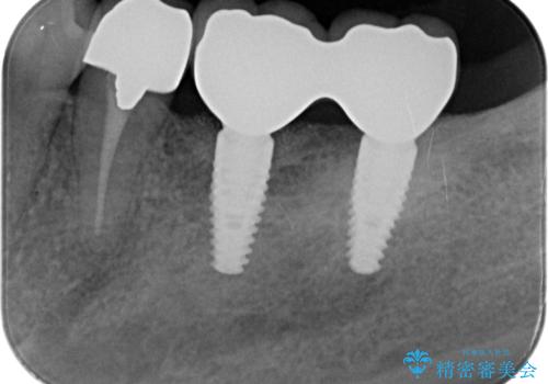 歯ブラシのしやすい環境を整えるインプラント治療の治療後