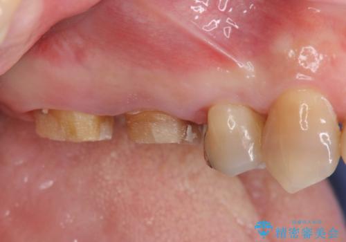 歯周ポケットの除去と再補綴治療の治療中