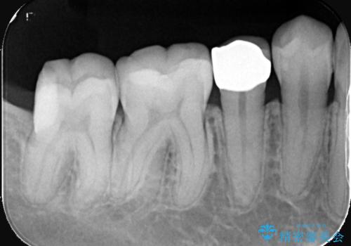見落としやすい虫歯(コンタクトカリエス)を発見|精密診断で早期治療の治療後