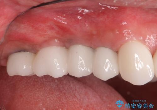 歯がずっと疼く 根本的な治療の希望の症例 治療後