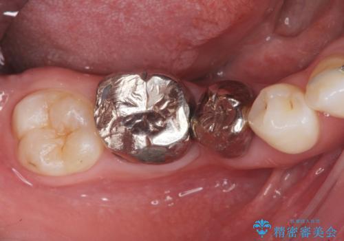 銀歯を白くしたい セラミック治療の治療前