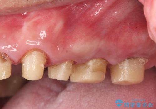 虫歯だらけの歯を治療したいの治療前