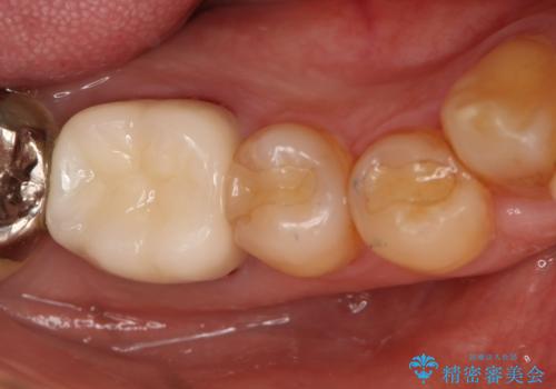 保険材料をセラミックにやり変えたい セラミックインレーの治療前