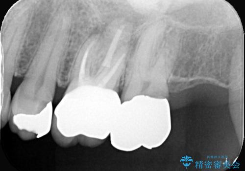 他院で治らなかった根管治療を精密治療で改善|MB2を発見し再治療の治療後