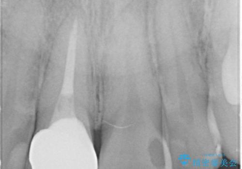 奥に引っ込んでいる前歯を並べたい 矯正治療とセラミック治療の治療後