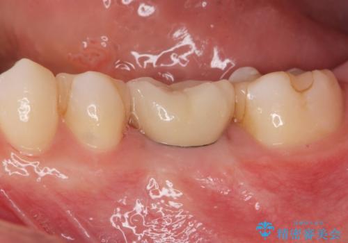 欠損部のインプラント補綴の症例 治療後