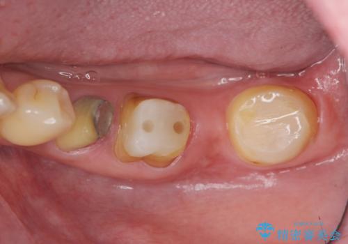 歯ブラシのしやすい環境を整えるインプラント治療の治療前