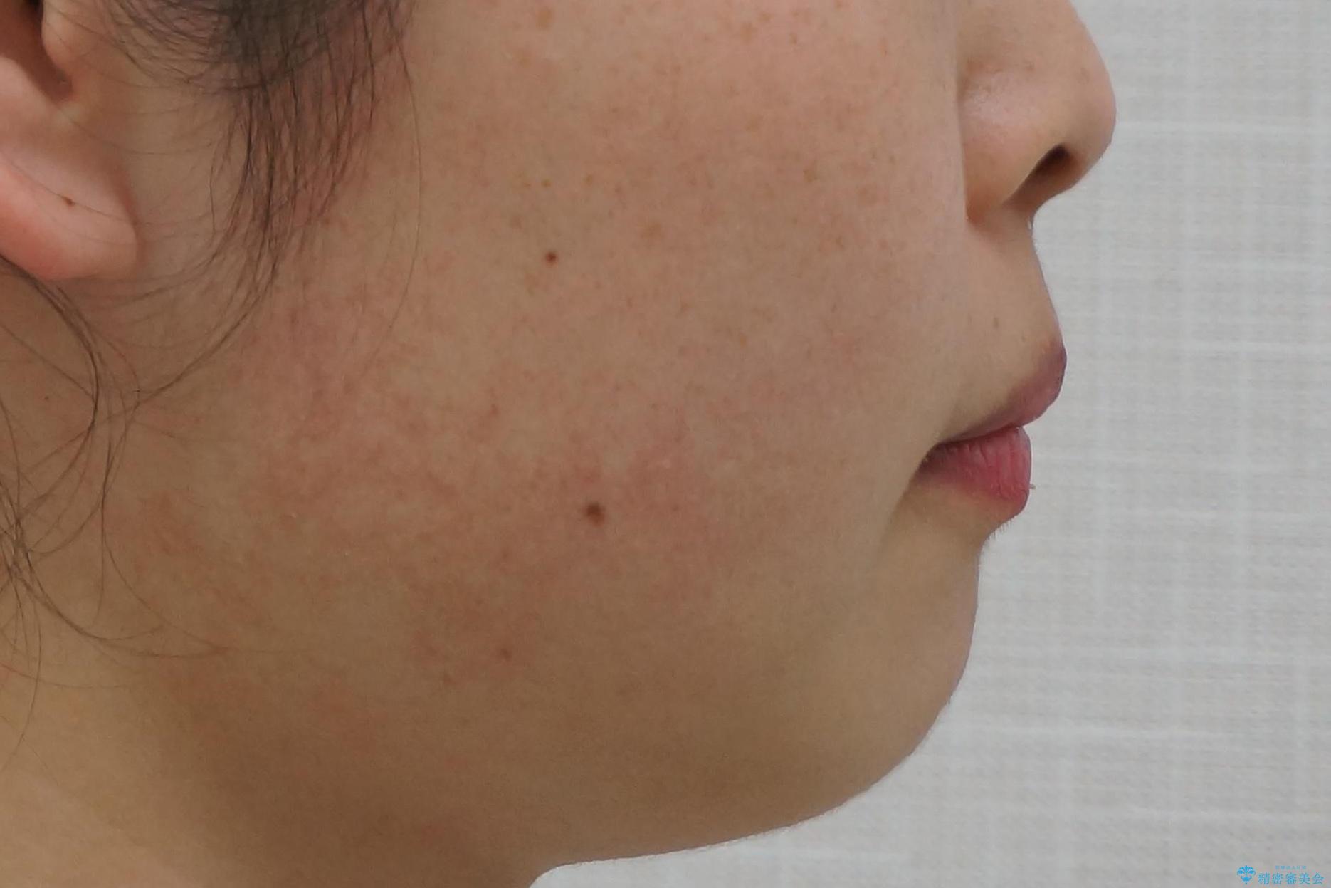 出っ歯の治療 抜かずに 短期間で目立たない治療の治療前(顔貌)