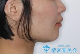 部分矯正で前歯をなおしたい→全顎ワイヤー矯正できちんと治すの治療後(顔貌)