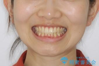下顎前歯の先天欠損と上顎前歯のクロスバイト:インビザライン治療の治療後(顔貌)