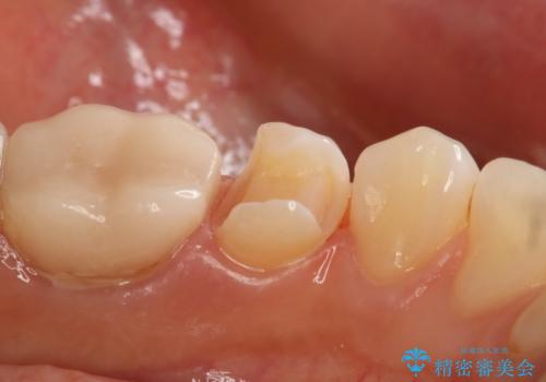 銀歯を白くしたい セラミックインレーの治療中