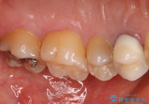 う蝕除去中に露髄 フルジルコニアクラウンの治療前