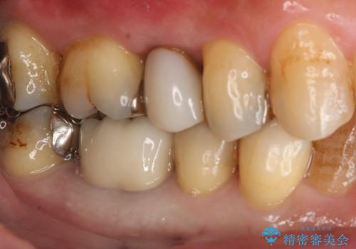 保険材料をセラミックにやり変えたい セラミックインレーの治療中