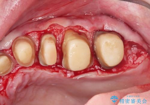 虫歯だらけの歯を治療したいの治療中