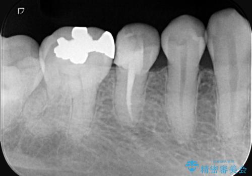 虫歯治療|歯を長持ちさせるための治療|セラミッククラウン|審美回復|精密根管治療の治療中
