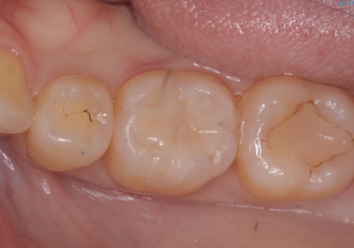 【セラミックインレー】プラスチックの劣化が気になるの治療後