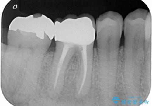 保険材料をセラミックにやり変えたい セラミックインレーの治療前