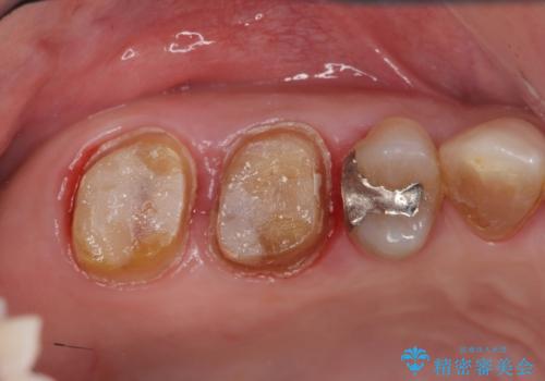 歯周ポケットの除去と再補綴治療の治療中