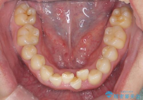 前歯のすき間 歯のがたつきの治療前