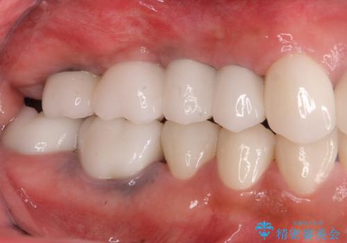 歯がずっと疼く 根本的な治療の希望の治療後